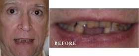 Before and After