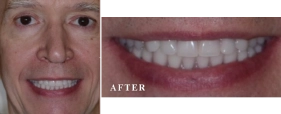 Before and After