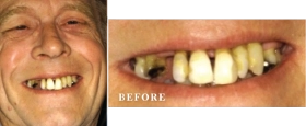 Before and After