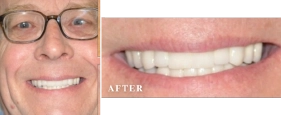 Before and After