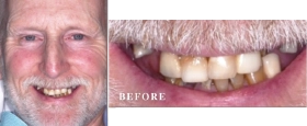 Before and After