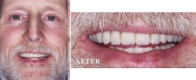 Before and After