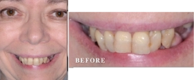 Before and After