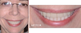 Before and After