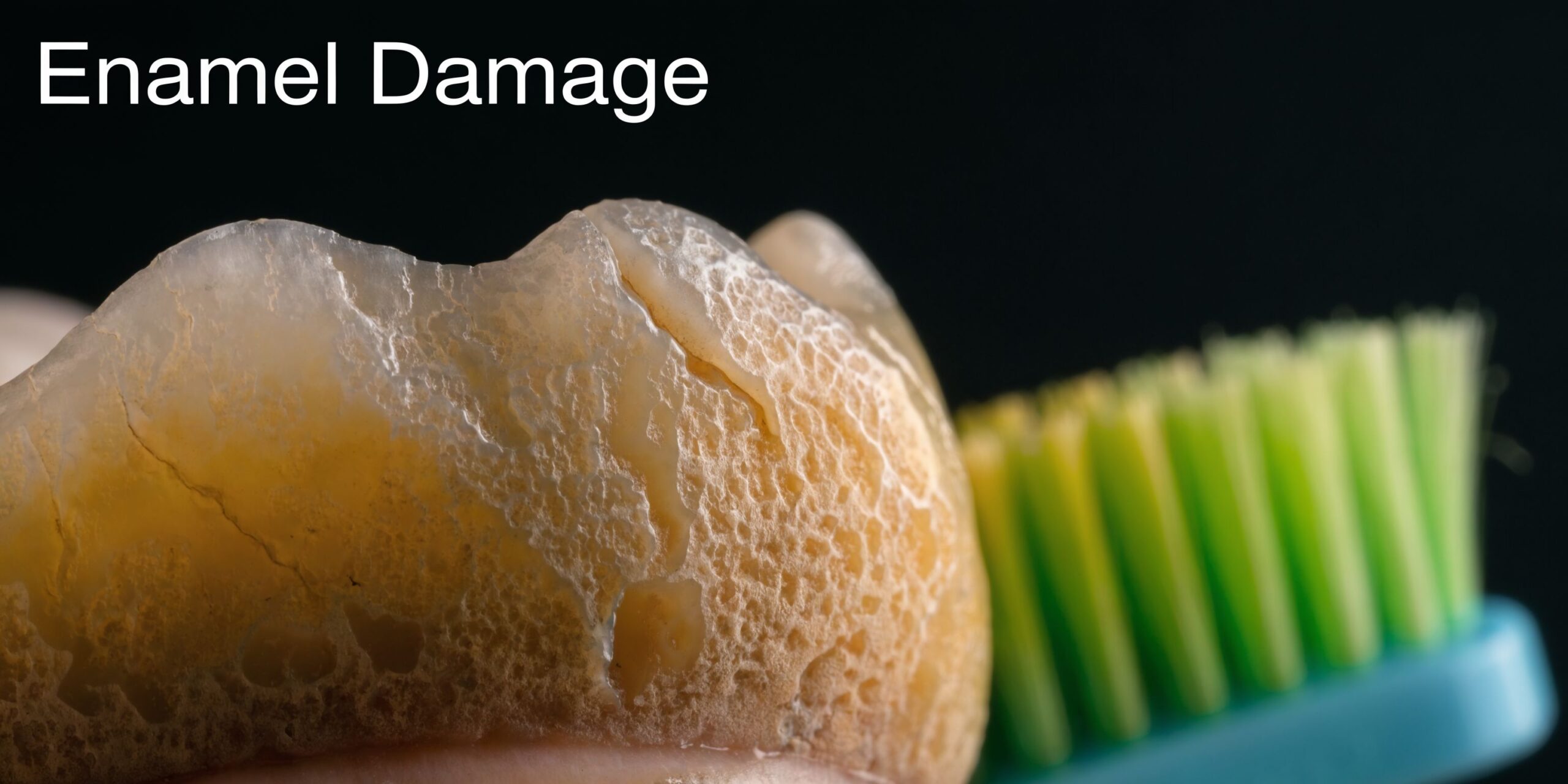 A close-up view of a severely damaged, eroded human tooth next to a soft-bristled toothbrush.