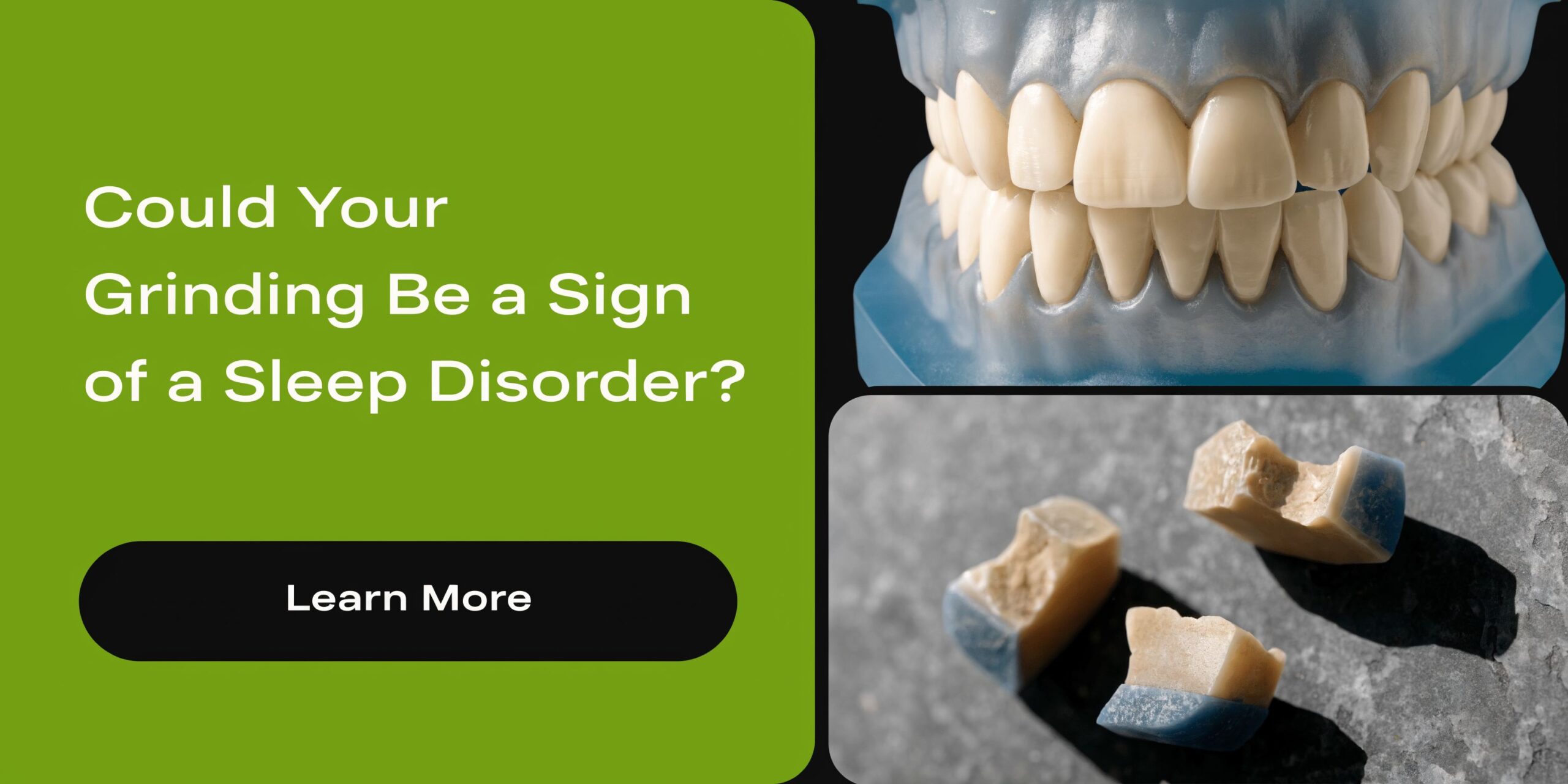 A model of teeth and broken pieces representing dental damage from grinding associated with a sleep disorder.