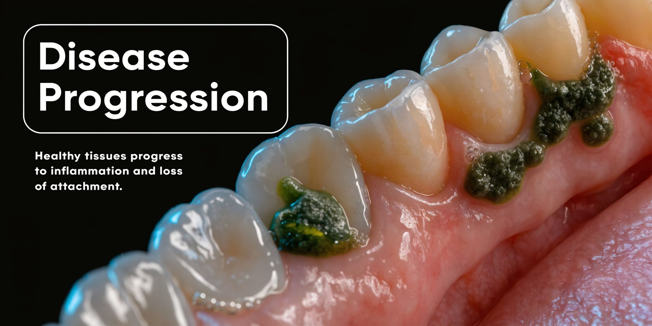 A close-up view of teeth showing significant gum disease and plaque accumulation along the gumline.