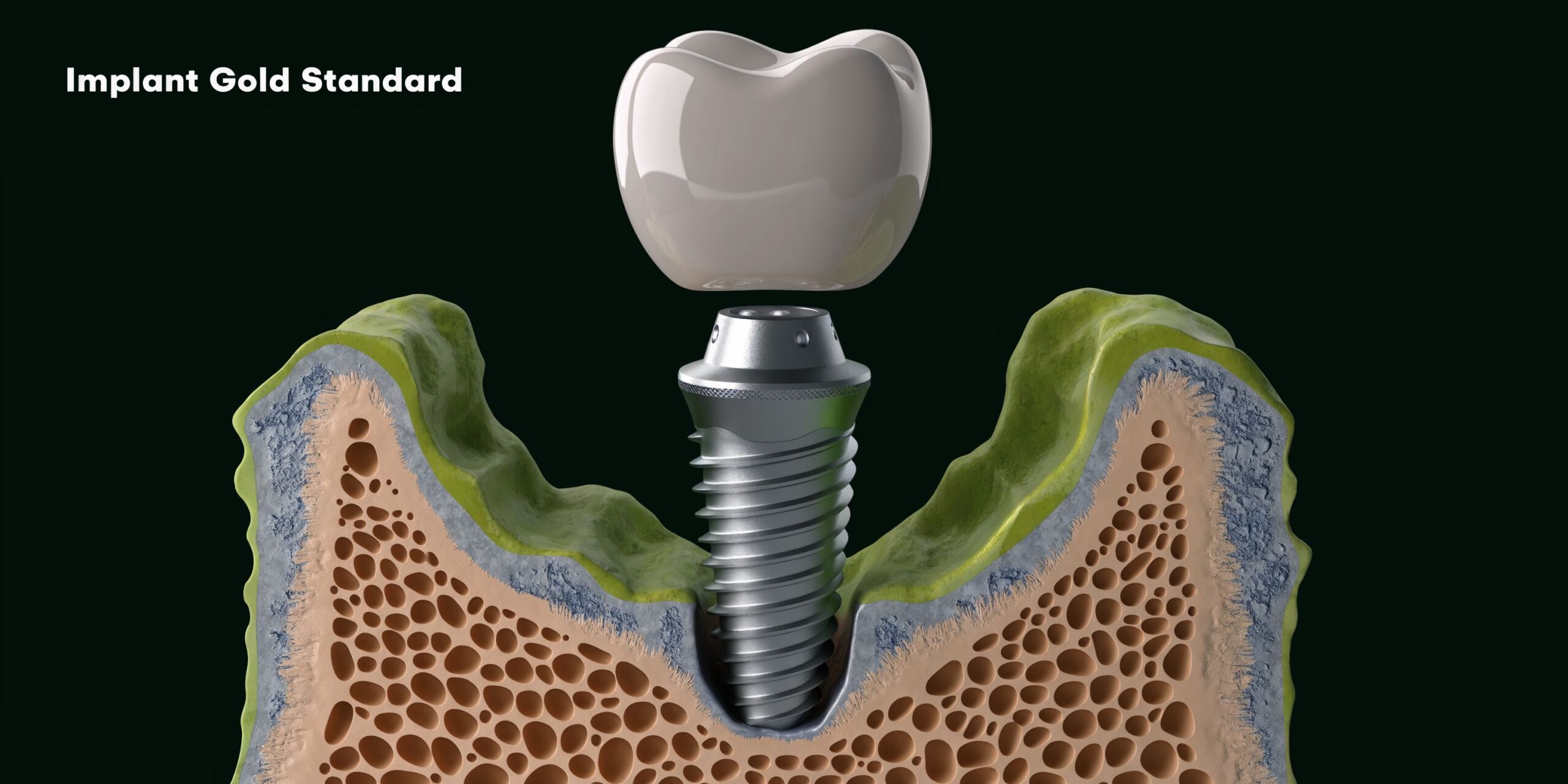 A 3D medical illustration showing a dental implant being placed into the jawbone and gum tissue.